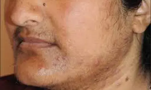 हातापायांवरचे केस लपवता येतात पण तोंडावरच्या केसांचं काय करावं बाई? हातापायांवरचे केस लपवता येतात पण तोंडावरच्या केसांचं काय करावं बाई?