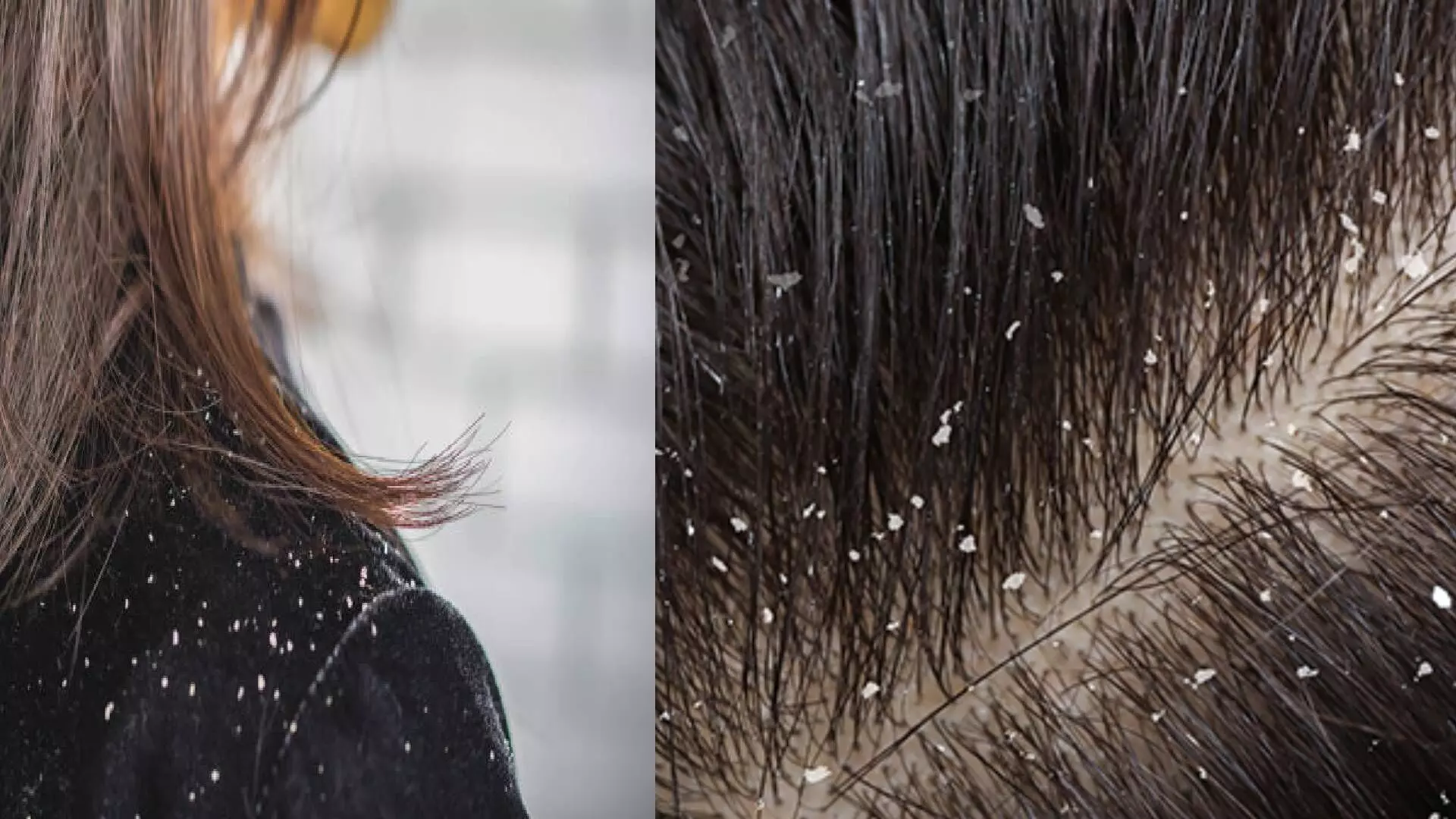 Dandruff डोक्यात कोंडा का होतो ?