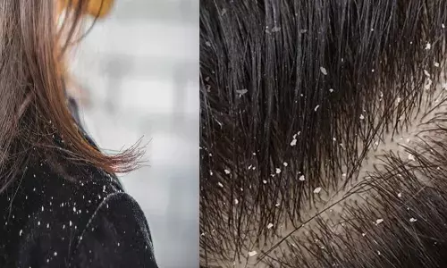 Dandruff डोक्यात कोंडा का होतो ? Dandruff डोक्यात कोंडा का होतो ?