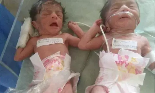 कोरोनाबाधित महिलेने दिला जुळ्या बाळांना जन्म कोरोनाबाधित महिलेने दिला जुळ्या बाळांना जन्म