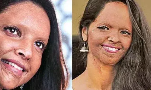 अ‍ॅसिड हल्ला आणि मी पहिल्यांदा पाहिलेला आरसा...